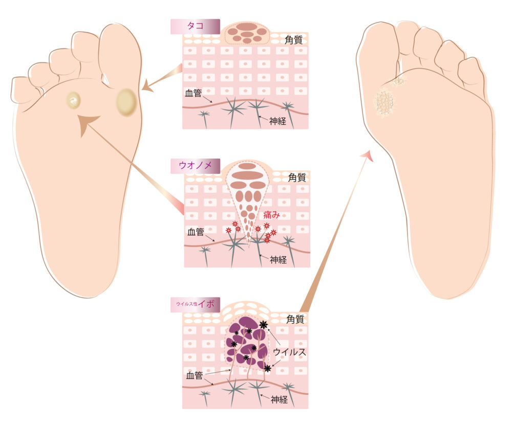魚の目（鶏眼）とタコ（胼胝）の原因や違いとは？